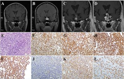 Sellar Glomus Tumor Misdiagnosed as Pituitary Adenoma: A Case Report and Review of the Literature